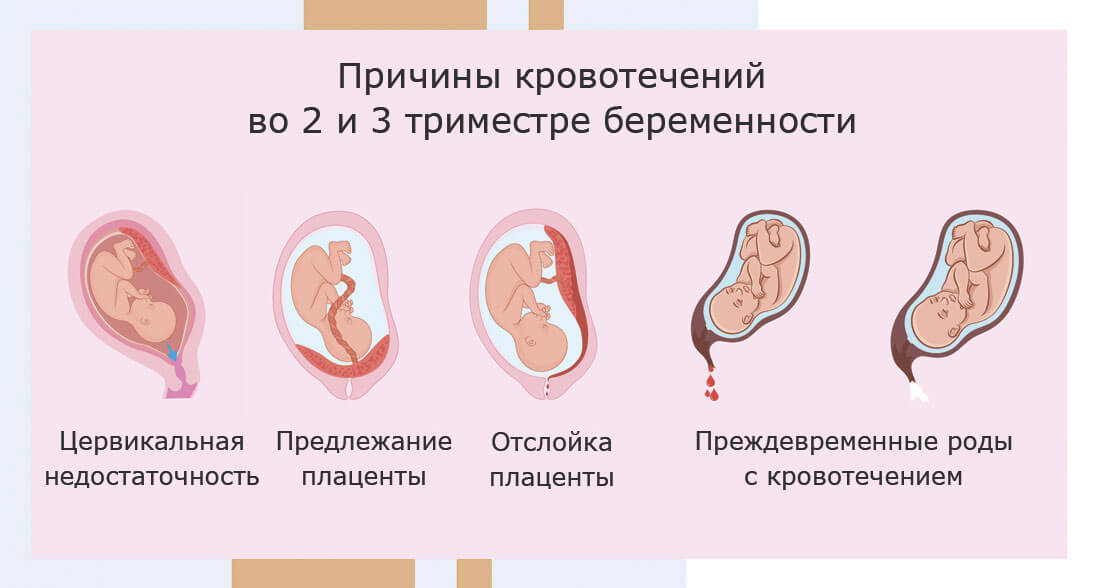 Кровянистые выделения при беременности в 1, 2, 3 триместрах