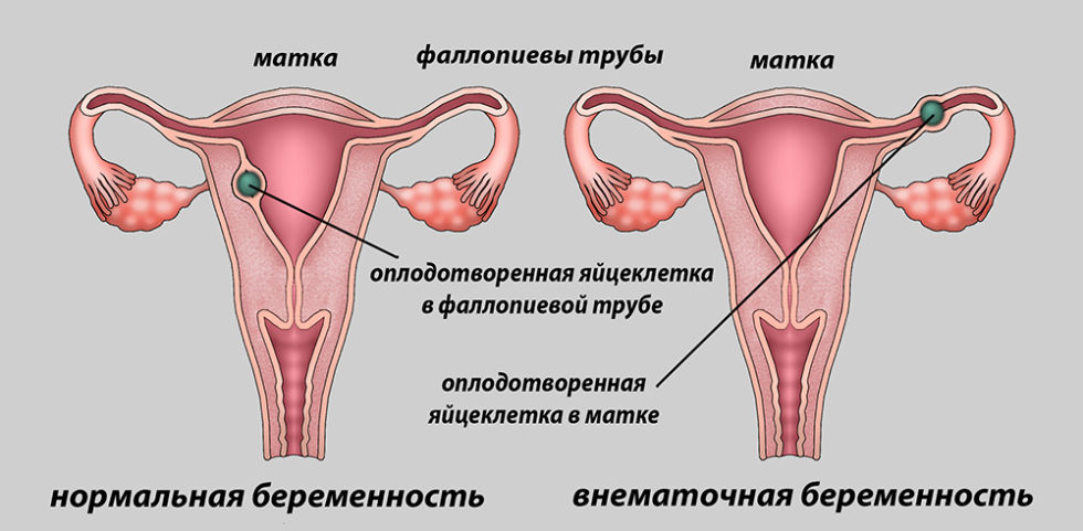 Профилактика внематочной беременности